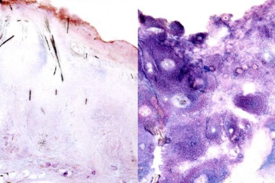 Image shows squamous cell skin cancer tumors with lactate production (a byproduct of glucose consumption) in purple. The tumor with lactate production blocked (left) grew at the same rate as the tumor with normal lactate production (right). Credit: UCLA B