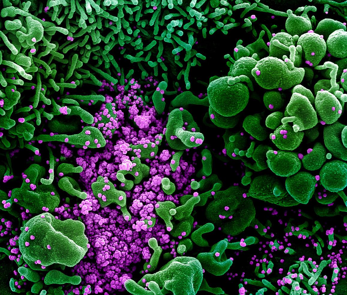 Colorized scanning electron micrograph of an apoptotic cell (green) heavily infected with SARS-COV-2 virus particles (purple), isolated from a patient sample. Image captured and color-enhanced at the NIAID Integrated Research Facility (IRF) in Fort Detric